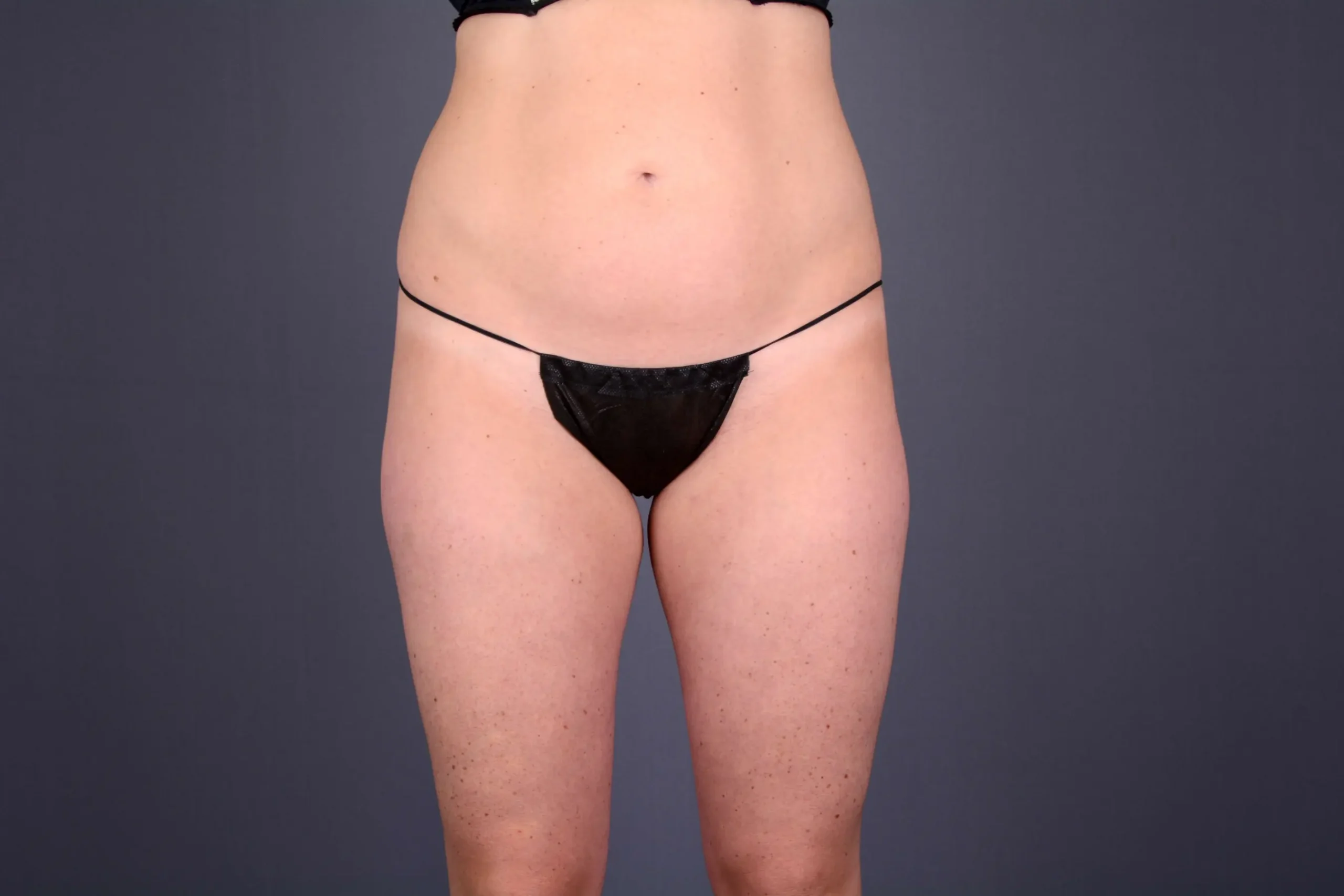 tummy tuck Las Vegas NV