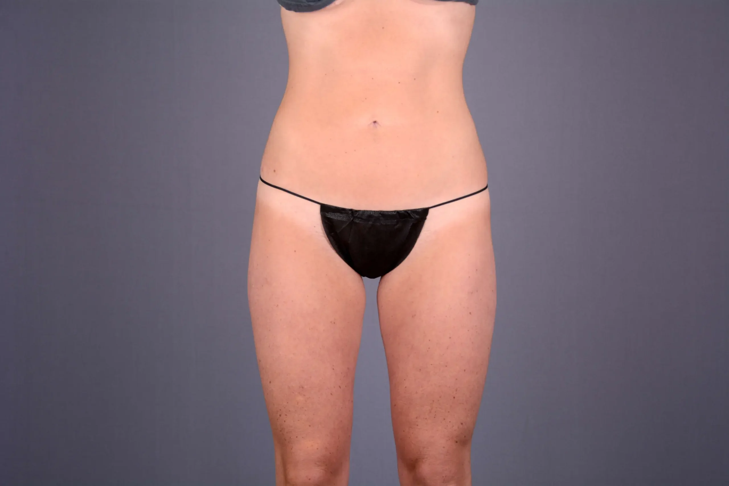 tummy tuck Las Vegas NV